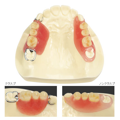 歯科材料通販フィード｜クラスプ/ノンクラスプ対比模型（フィード）の通販