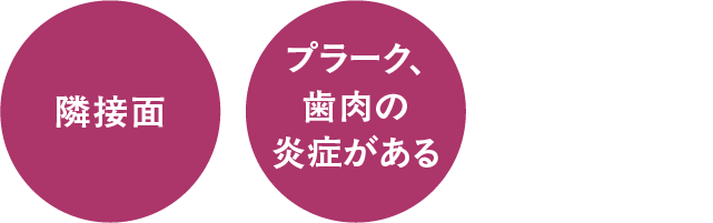 隣接面、プラーク・歯肉の炎症がある